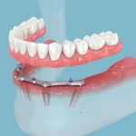Smiles Rebuilt: The Full-Arch All-on-4 Implant Solution and What You Need to Know