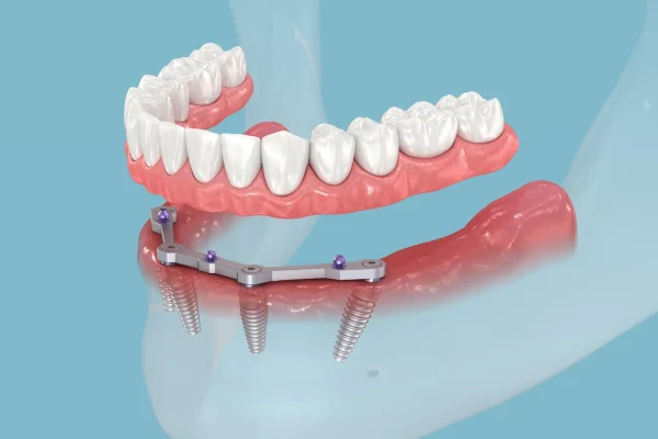 Smiles Rebuilt: The Full-Arch All-on-4 Implant Solution and What You Need to Know