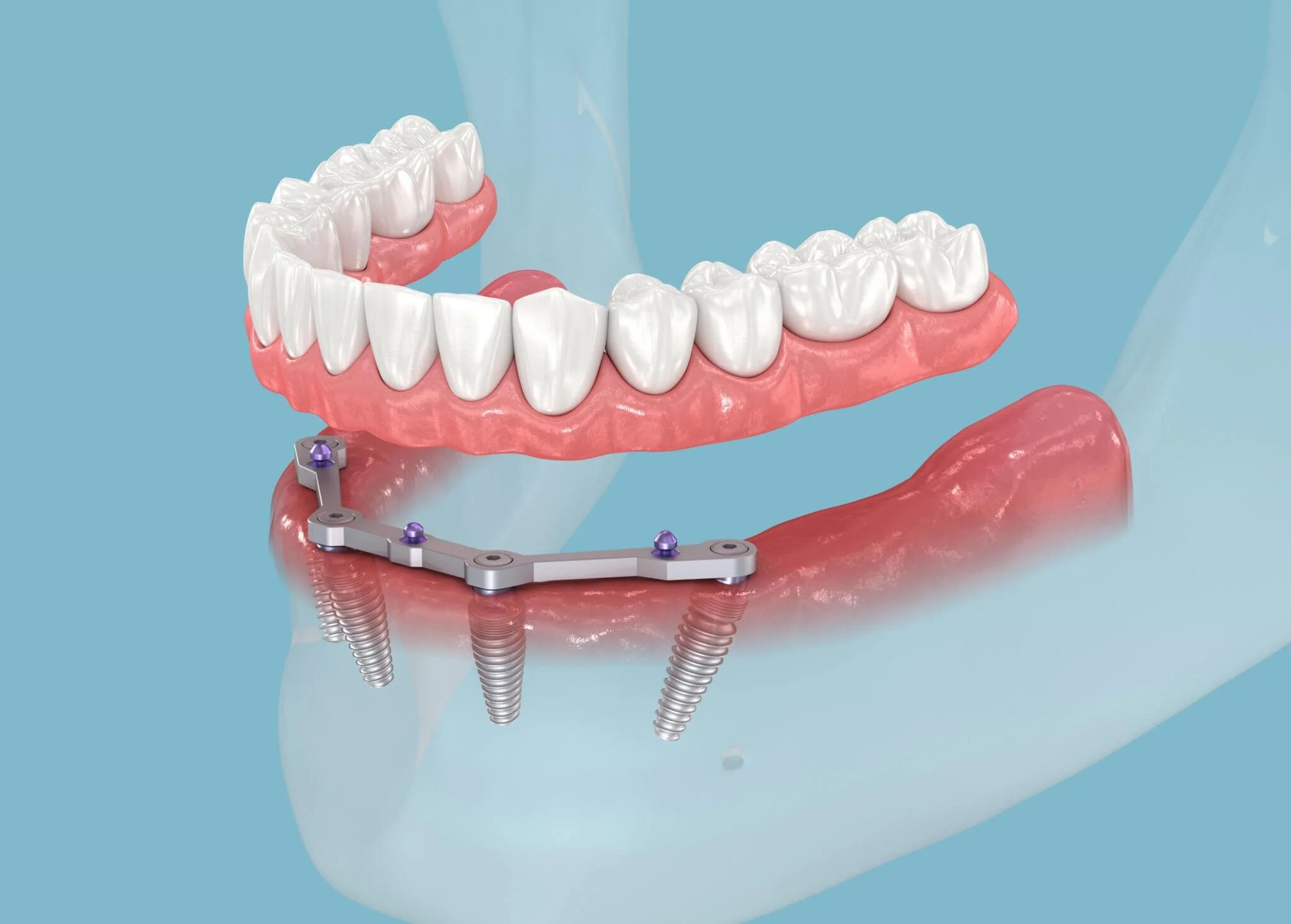 Smiles Rebuilt: The Full-Arch All-on-4 Implant Solution and What You Need to Know