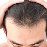 The Confidence Boost of Visiting a Hair Loss Clinic Brighton